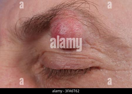 Augenbrauenzyste bei einem 54-jährigen Mann. Stockfoto