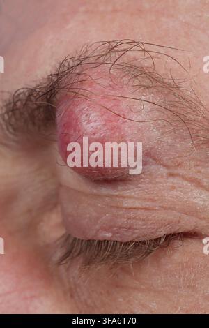 Augenbrauenzyste bei einem 54-jährigen Mann. Stockfoto