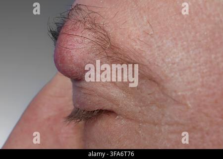 Augenbrauenzyste bei einem 54-jährigen Mann. Stockfoto
