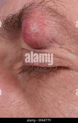 Augenbrauenzyste bei einem 54-jährigen Mann. Stockfoto