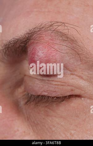 Augenbrauenzyste bei einem 54-jährigen Mann. Stockfoto