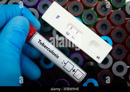 Blutprobe eines Patienten mit positivem Ergebnis auf Tuberkulose. Stockfoto