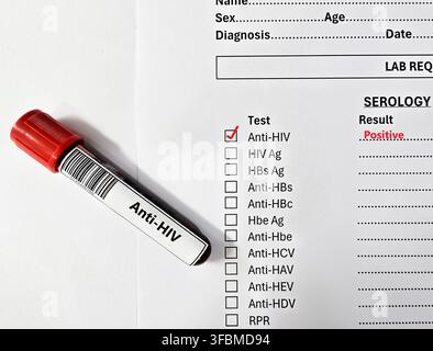 Blutprobe eines Patienten-positiven HSV-Ergebnisses. Stockfoto