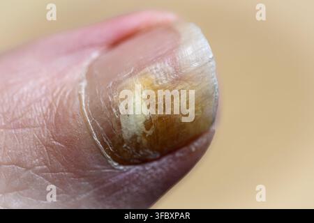 Stumpfer Nagel zeigt Anzeichen einer Pilzinfektion. Fingerspitze hält einen beschädigten Nagel im Nahaufnahme. Verfärbung breitet sich über die Nageloberfläche aus. Natürlicher Hautton Stockfoto