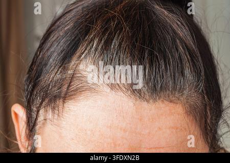 Eine detaillierte Ansicht der Kopfhaut einer Person, die spärliches Haarwachstum und eine deutliche Haarlinie zeigt, die sich zurückzieht, und damit Haarausfallprobleme hervorhebt Stockfoto