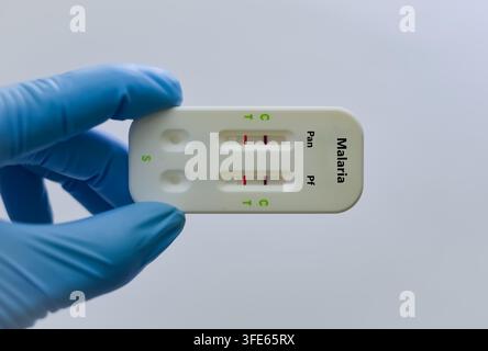 Blutprobe eines Patienten mit positivem Malariabefund Stockfoto