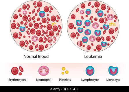 Normales Blut und Leukämie, die Erythrozyten, Neutrophile, Thrombozyten, Lymphozyten und Monozyten zeigen Stock Vektor
