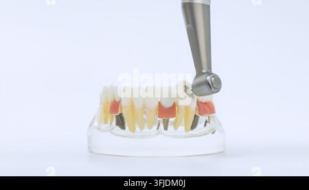Dentales Berufsgerät mit Polierkuppe, das an einem pädagogischen Acryl-Kiefermodell mit Titanimplantaten arbeitet. Stockfoto