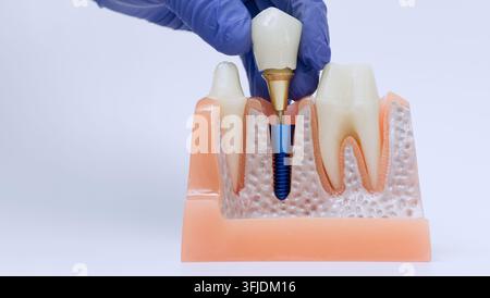 Nahaufnahme einer implantatgestützten Zahnrestauration mit der Hand eines Zahnarztes, die Krone und Pfeiler in ein anatomisches Kiefermodell einsetzt Stockfoto