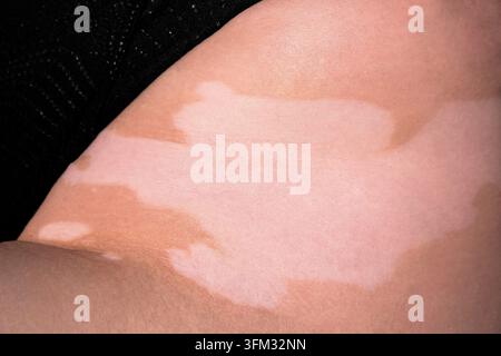 Haut mit Vitiligo. Weibliche Beine und Arme mit Autoimmunerkrankung. Pigmentierung Stockfoto