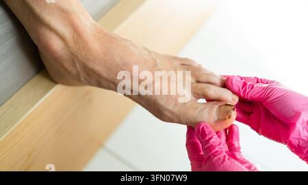 Ein Arzt untersucht einen infizierten Nagel und einen verletzten Nagel am Finger eines Patienten in einer sterilen Klinik. Der besorgte Arzt behandelt einen beschädigten Nagel und diagnostiziert Nageltrauma in einem weißen Behandlungsraum. Stockfoto