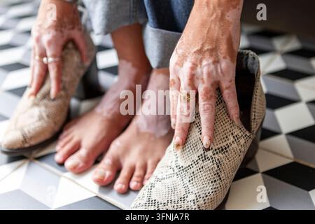 Nahaufnahme einer Frau mit Vitiligo an Händen und Füßen, die strukturierte Schuhe anzieht, während sie barfuß auf einem schwarz-weiß gemusterten Fliesenboden steht Stockfoto