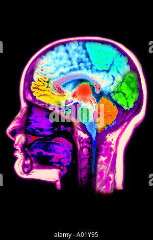 MRT des Gehirns zeigen normale Anatomie Stockfoto