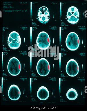 CT-Scan des Gehirns 10 jährige junge epidurales Hämatom von Trauma.  Die Ventrikel sind komprimiert und seitlich versetzt Stockfoto