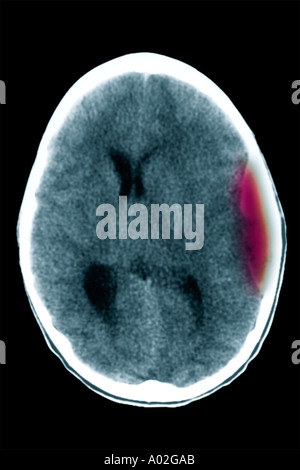 CT-Scan des Gehirns 10 jährige junge epidurales Hämatom von Trauma.  Die Ventrikel sind komprimiert und seitlich versetzt Stockfoto