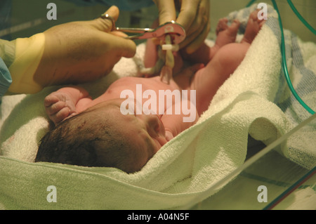 Abnabelung des Neugeborenen Stockfoto