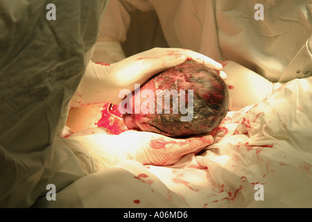 Die Geburt eines Babys per Kaiserschnitt, Kaiserschnitt, Kaiserschnitt zeigt den Kopf entstehen. Stockfoto