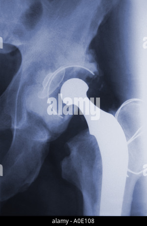 Künstliches Hüftgelenk X-Ray Stockfoto