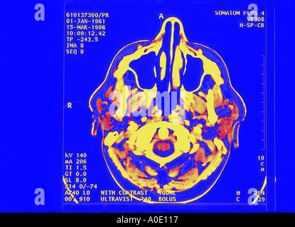 Gehirn-Scan Stockfoto