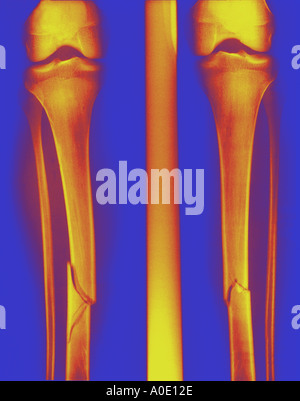 Gebrochenen Tibia Stockfoto