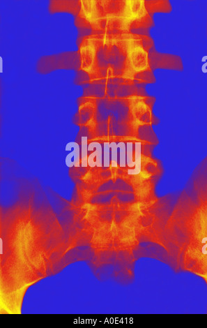Wirbelsäule-X-ray Stockfoto