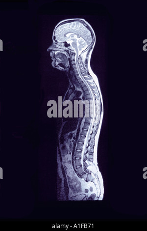 MRI-Bild von mans Skelett Stockfoto