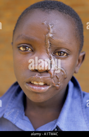 RÜCKKEHR NACH RUANDA MÄRZ 1995 JEROME GATETE 13 DURCH EINE GRANATE IM GESICHT VERLETZT Stockfoto