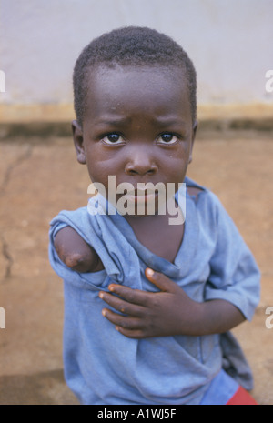 AMPUTIERTE SIERRA LEONE. Kind mit einem ARM AMPUTIERT böswillig von Rebellen 1999 Stockfoto
