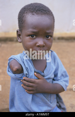 AMPUTIERTE SIERRA LEONE KIND MIT EINEM ARM AMPUTIERT BÖSWILLIG VON REBELLEN 1999 Stockfoto