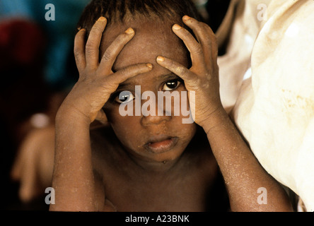 HUNGERSNOT IM SUDAN 1985 GIRBA FLÜCHTLINGSLAGER AN GRENZE ZU ÄTHIOPIEN GAB PROVINZ Stockfoto