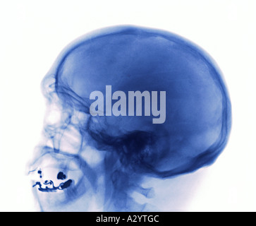 X-ray einen Schädelbruch Stockfoto