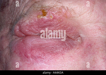 Herpes Zoster Gürtelrose Hautausschlag im Gesicht Stockfoto