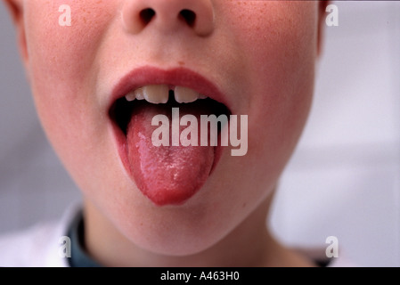 Kind mit Scharlach Stockfoto