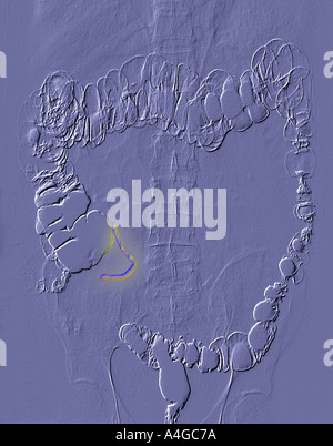 Barium Enema Xray zeigt Anhang und Divertikel gelb hervorgehoben Stockfoto