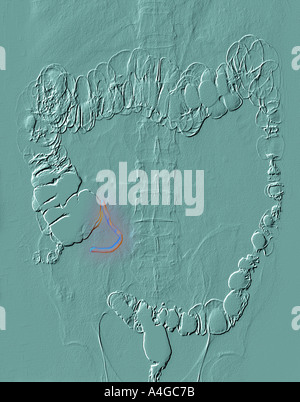 Barium Enema Xray zeigt Anhang gelb und Divertikel Stockfoto