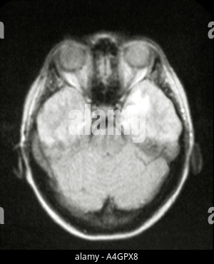 Ein Kernspinresonanz (NMR) Scan eines Patienten mit einem Gliom Stockfoto