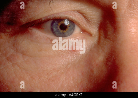 Ein Foto von einem Basalzellkarzinom Stockfoto