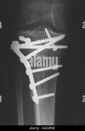 Eine Röntgenaufnahme einer Tibia Plateau-Fraktur mit einer Stütze Platte fixiert Stockfoto