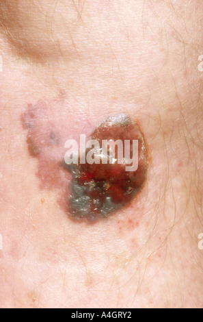 Ein Foto von ein malignes Melanom am Bein zeigt unregelmäßige Ränder und knotige Teile des Tumors. Nahaufnahme der Läsion. Stockfoto