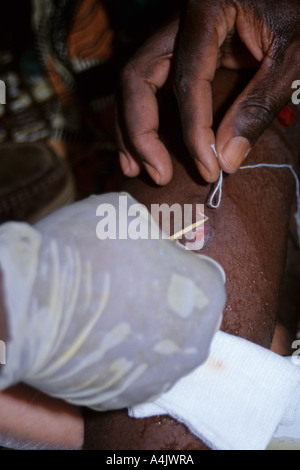 Schleife Faden um Medinawurm aus Bein, in der Nähe von Tera, Niger, Westafrika. Stockfoto