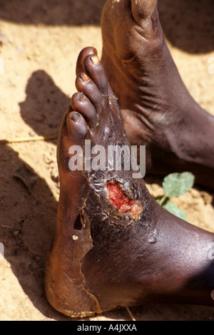 Sekundarinfektion Verursacht Durch Medinawurm Wunde Niger Stockfotografie Alamy