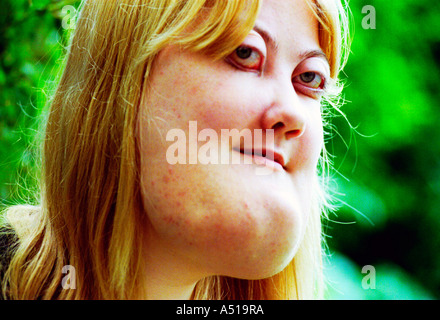 Eine junge Frau mit Cherubism.  Der seltenen genetischen Krankheit ist eine erbliche Form der polyostotisch Fibröser Dysplasie. Stockfoto