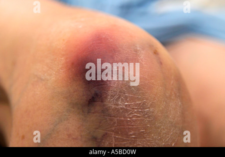 ältere Frau mit einem großen Bluterguss am Knie Stockfoto