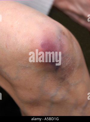 ältere Frau mit einem großen Bluterguss am Knie Stockfoto