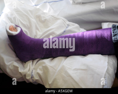 Acht Jahre altes Mädchen mit lila Gipsverband am Bein im Krankenhaus Stockfoto