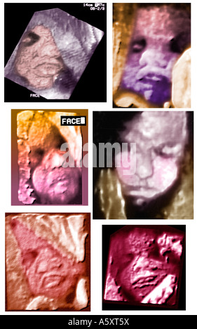 3D Ultraschall menschlichen Fötus im Uterus der Mutter Stockfoto