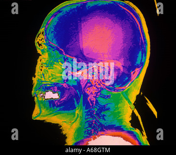 Farbe-CT-Scan der lateralen Schädelbasis Stockfoto