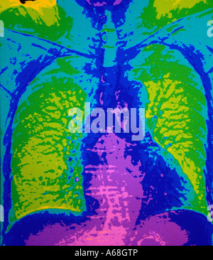 CT-Untersuchung der Brust und Lunge Stockfoto