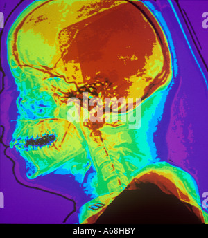 Farbe-CAT-Scan der lateralen Schädelbasis Stockfoto