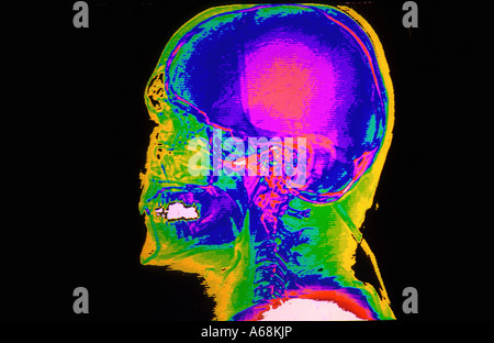 Farbe-CAT-Scan der lateralen Schädelbasis Stockfoto